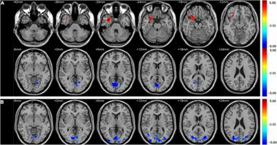 Aberrant Brain Spontaneous Activity and Synchronization in Type 2 Diabetes Mellitus Subjects Without Mild Cognitive Impairment